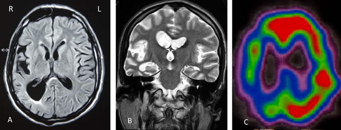 Corticobasal Syndrome In A Family With Early Onset Alzheimer S