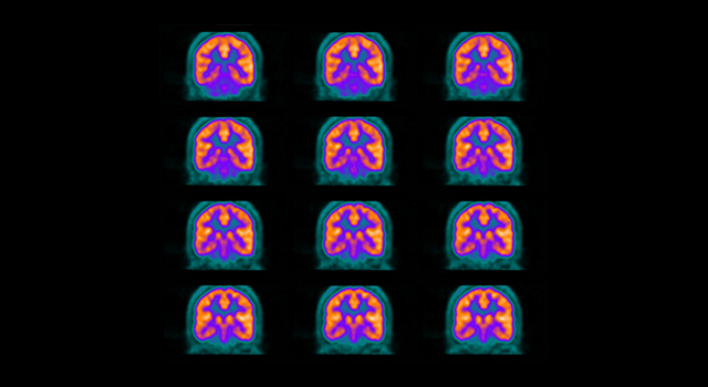 ‘Ambitious’ study investigates use of PET imaging biomarkers for Huntington's disease